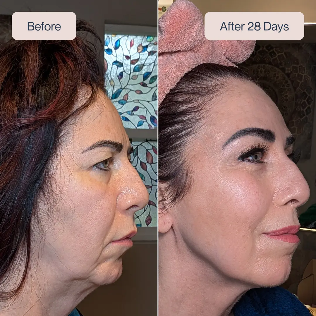 InnirSkin LED Skin Lift Pro